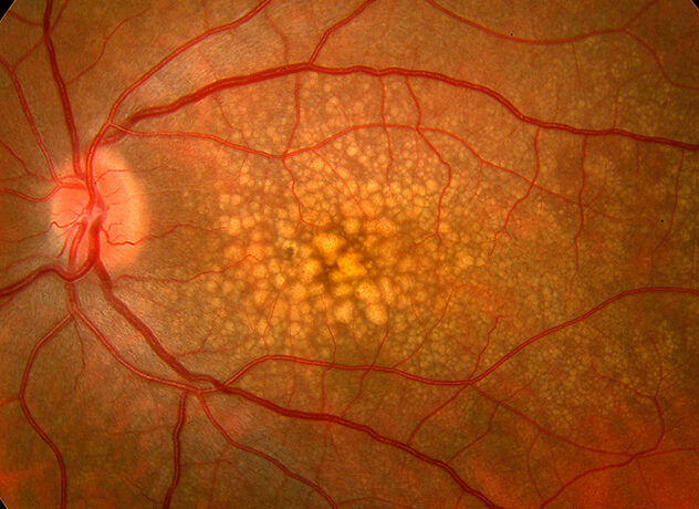 Macular Degeneration