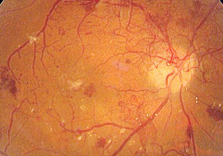 Diabetic Eye Care