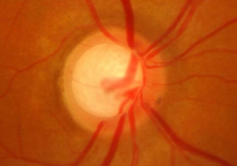 Illustration showing elevated eye pressure in glaucoma