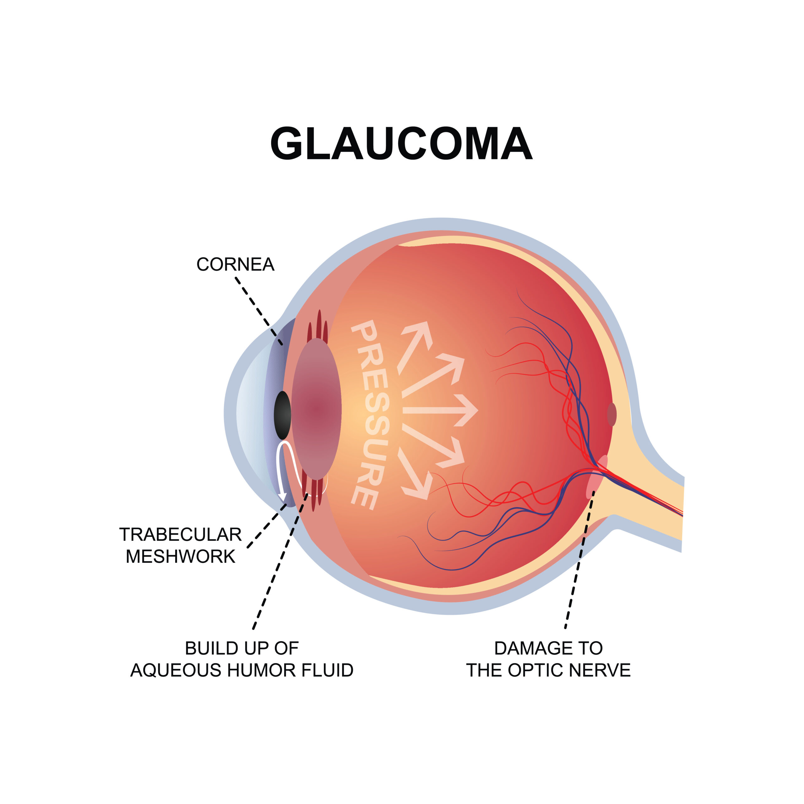 glaucoma eye vector design
