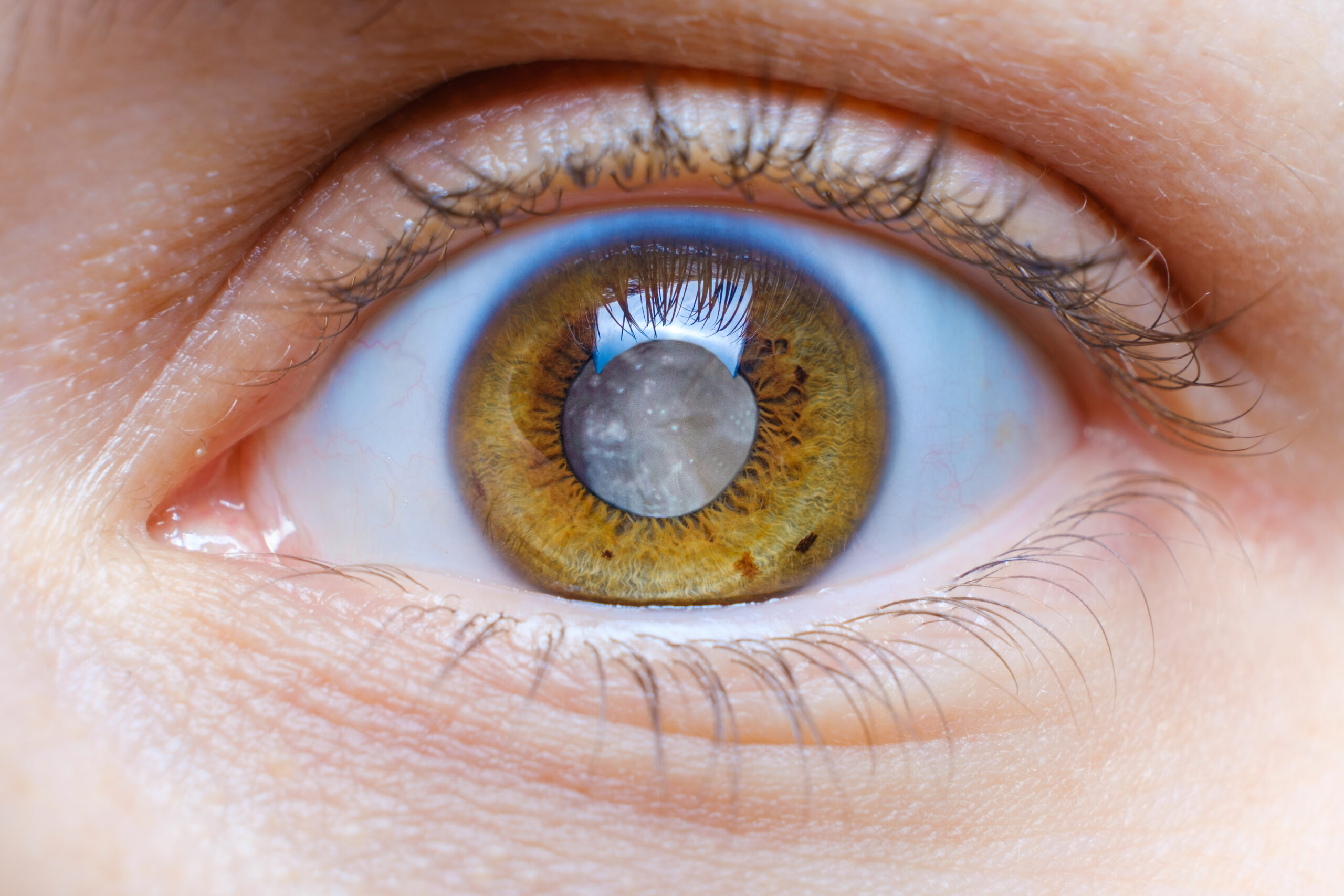 Patient discussing cataract surgery in Saginaw with an ophthalmologist