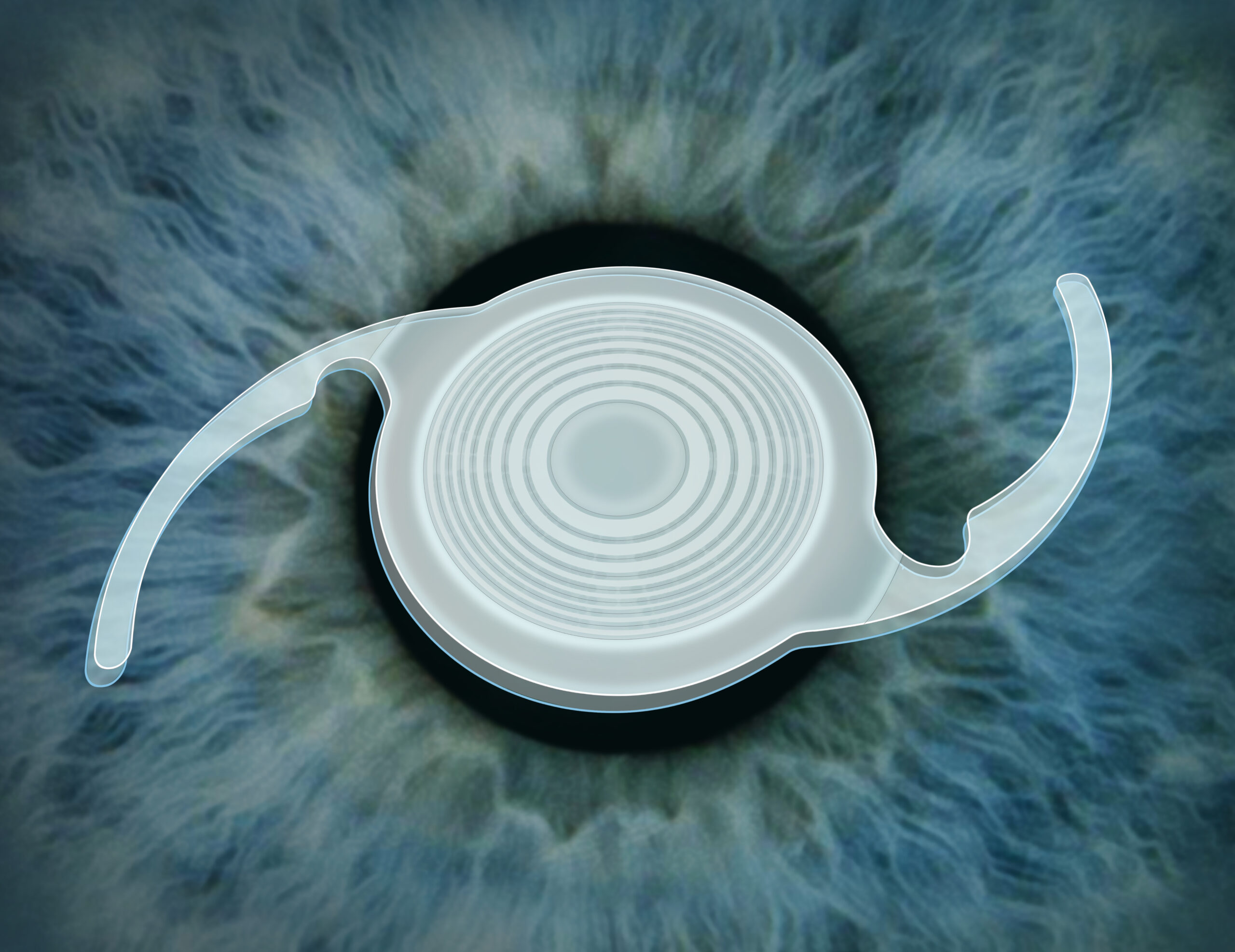 Multifocal lens option