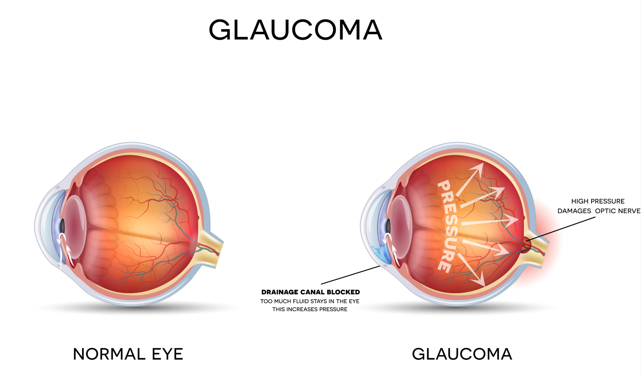 Eye pressure awareness