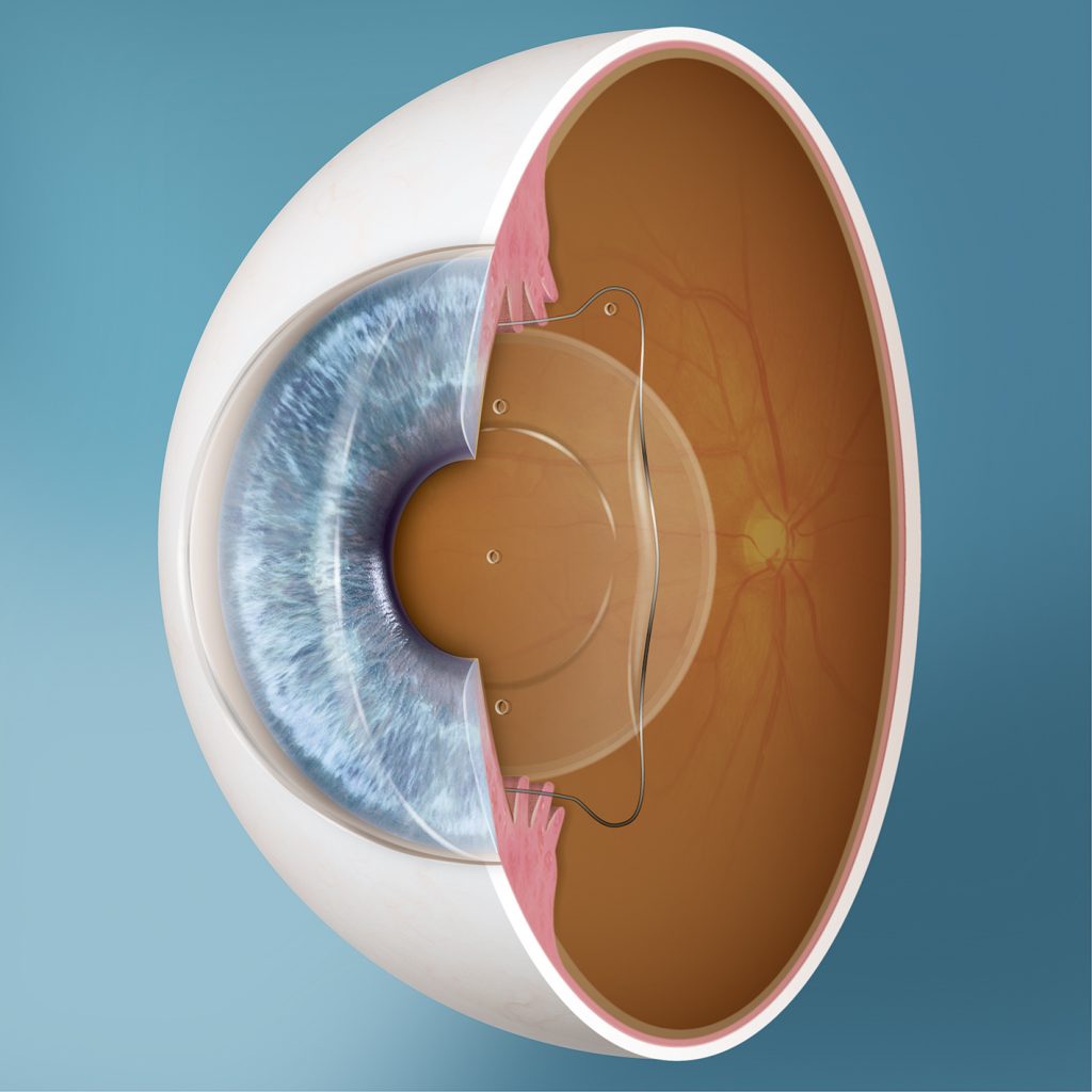 Implantable Collamer Lenses