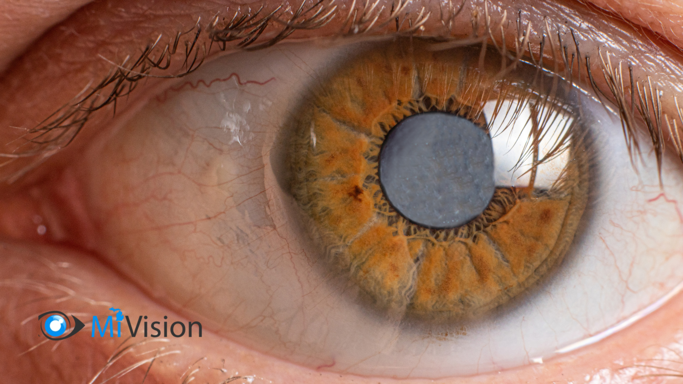 Cataract Surgery Recovery