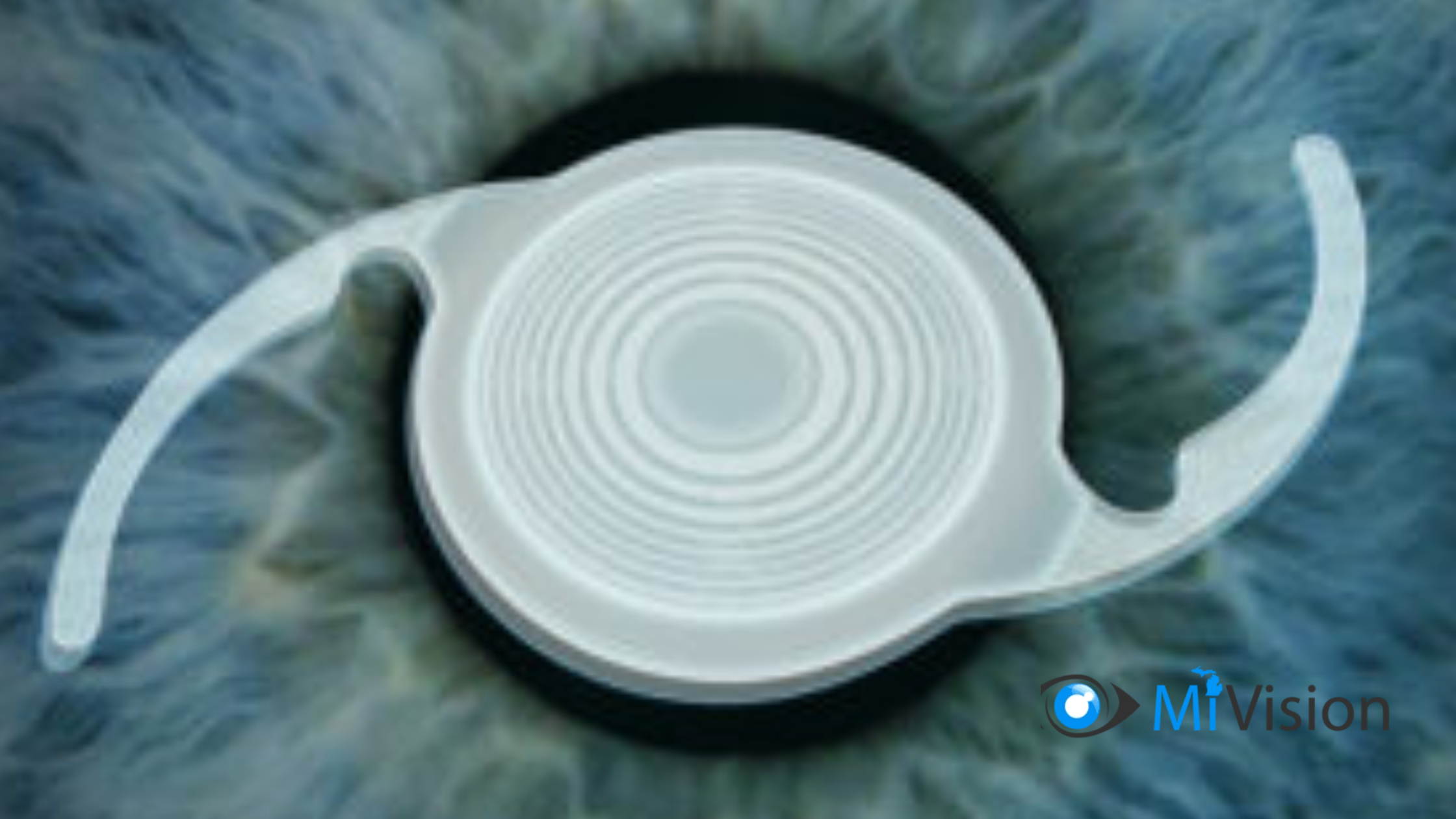 cataract surgery recovery