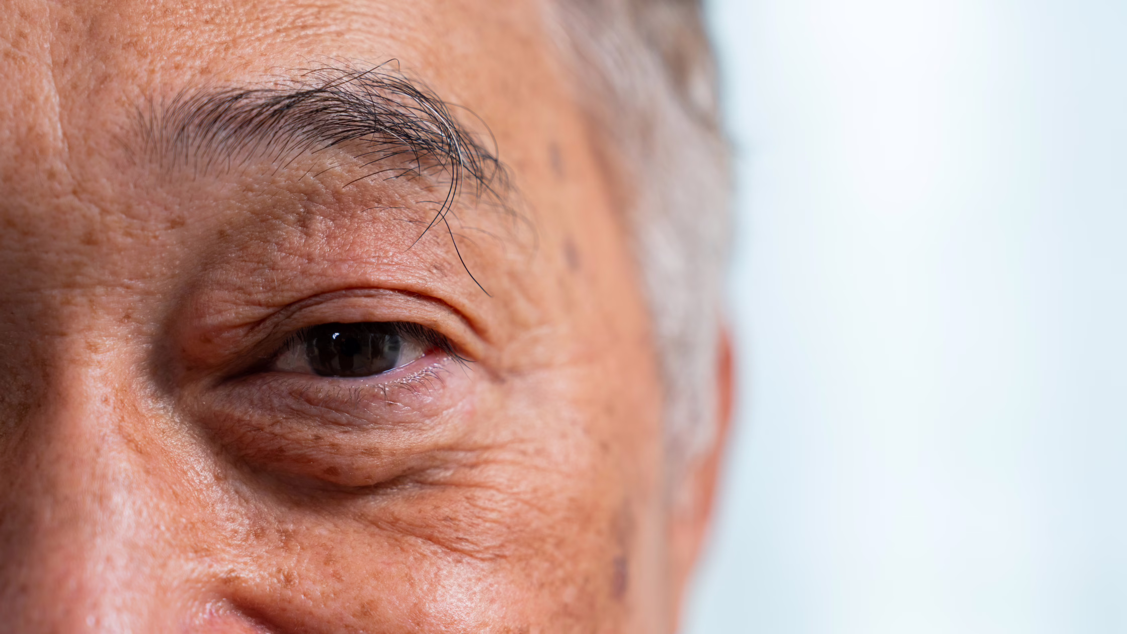 Can Cataracts Come Back After Surgery