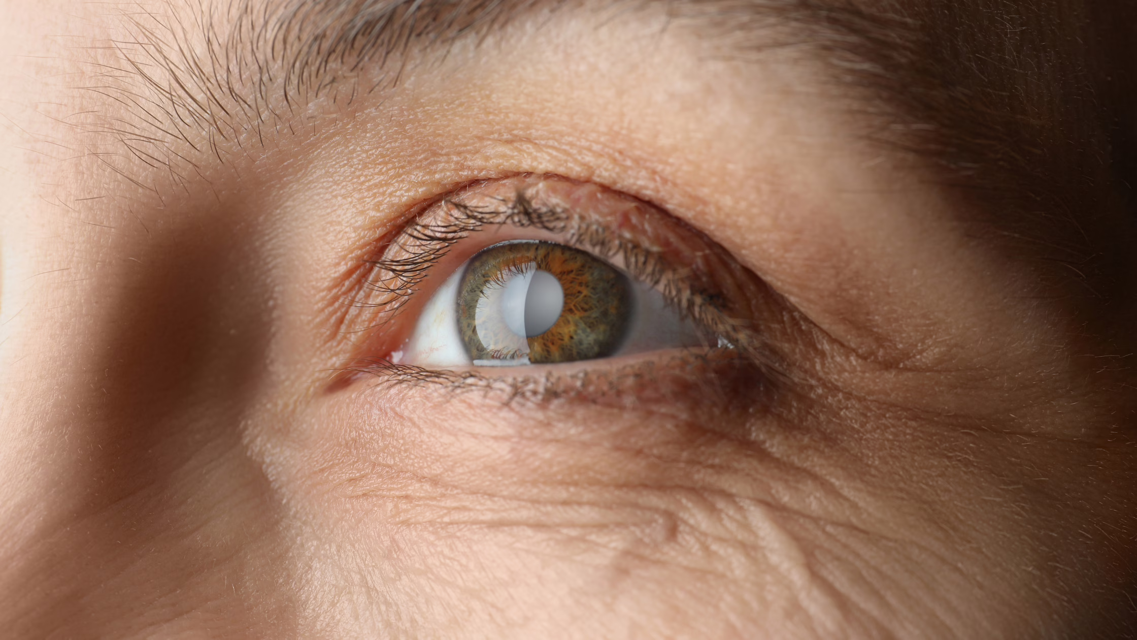 Can Cataracts Come Back After Surgery